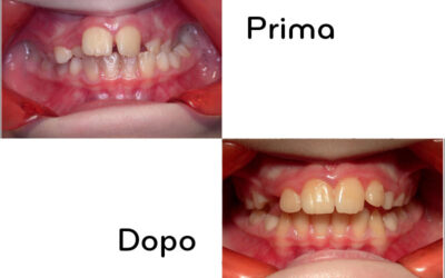 L’analisi delle aree di densità ossea mascellare e mandibolare nella diagnosi osteopatica delle malocclusioni